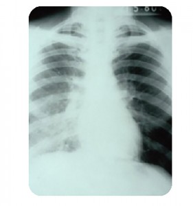 Legionella'ya ile enfekte bir akciğer